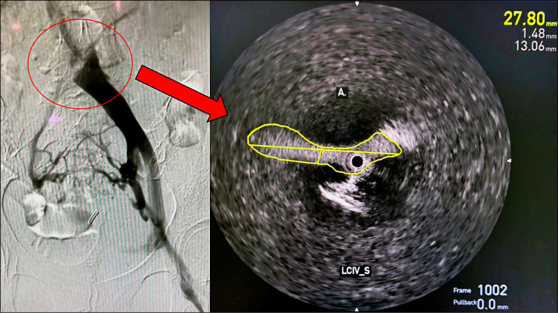 ▲左髂靜脈顯示嚴重狹窄,影像證實血流受阻為主要病因。(照片提供/醫師蔡承根) ▲左髂靜脈顯示嚴重狹窄,影像證實血流受阻為主要病因。(照片提供/醫師蔡承根)