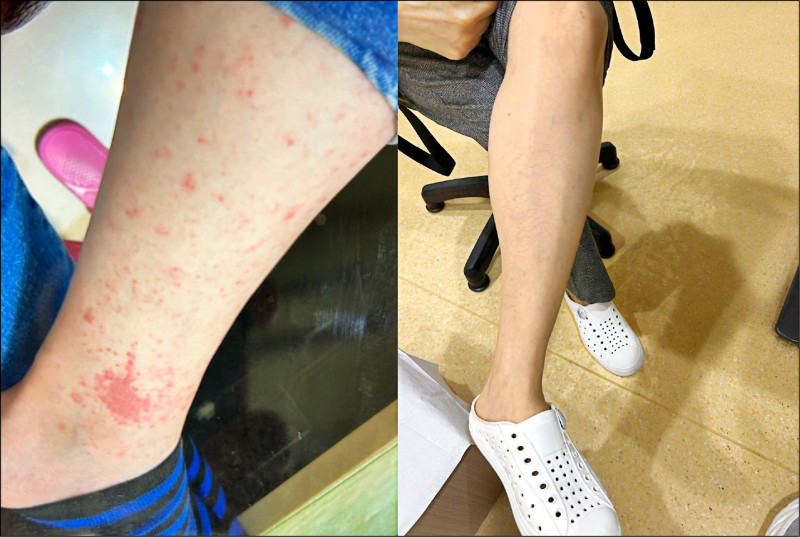 ▲術前左小腿嚴重紅疹與紅斑,術後3個月皮膚恢復平穩如常,症狀顯著改善。(照片提供/醫師蔡承根) ▲術前左小腿嚴重紅疹與紅斑,術後3個月皮膚恢復平穩如常,症狀顯著改善。(照片提供/醫師蔡承根)