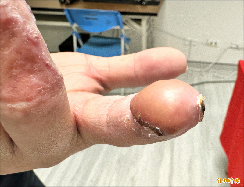 ▲梁先生的左手食指術後恢復良好。(記者許麗娟攝) ▲梁先生的左手食指術後恢復良好。(記者許麗娟攝)