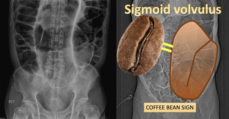 老翁腹部X光顯示乙狀大腸異常脹大,呈現像咖啡豆般的腸氣影像。(民生醫院提供) 老翁腹部X光顯示乙狀大腸異常脹大,呈現像咖啡豆般的腸氣影像。(民生醫院提供)