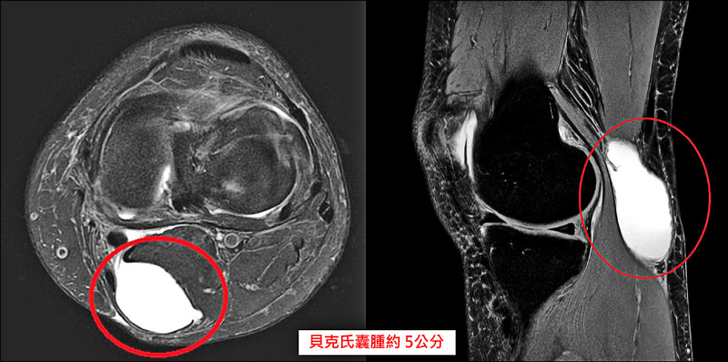 婦後膝窩長腫塊、蹲跪會麻 揪出「貝克氏囊腫」作怪