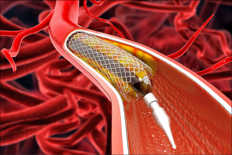 ▲心導管支架的使用年限，取決於血管本身的狀況，以及病人後續的生活習慣與用藥控制；示意圖。（照片來源：shutterstock）