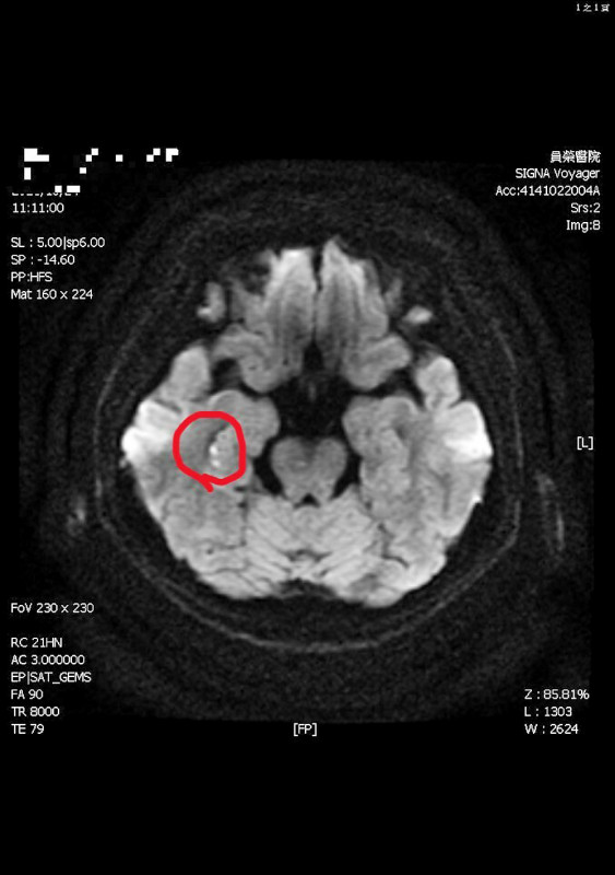 ▲醫生表示,從MRI可看出右側海馬迴有一點亮亮的影像,(圖中紅圈亮點處),證實是因情緒激動引發局部中風,導致「短暫性全面失憶」。(員榮醫院提供) ▲醫生表示,從MRI可看出右側海馬迴有一點亮亮的影像,(圖中紅圈亮點處),證實是因情緒激動引發局部中風,導致「短暫性全面失憶」。(員榮醫院提供)