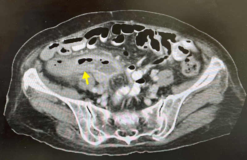 台中94歲嬤超隱忍  腹痛半年查出大腸癌、切腸道60公分