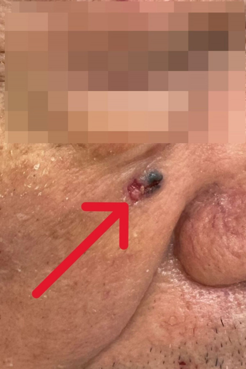 陳先生右臉出現黑色斑塊(左),切片檢驗確診為基底細胞癌。(台北慈濟醫院提供) 陳先生右臉出現黑色斑塊(左),切片檢驗確診為基底細胞癌。(台北慈濟醫院提供)