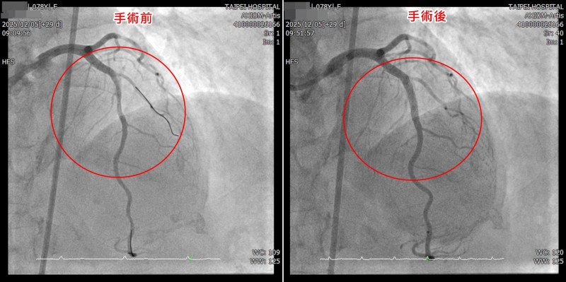 左圖為治療前左前降支嚴重鈣化狹窄、血流受阻;右圖經血管內震波碎石術與支架置放後,血管成功擴張,血流明顯改善。(衛福部台北醫院提供) 左圖為治療前左前降支嚴重鈣化狹窄、血流受阻;右圖經血管內震波碎石術與支架置放後,血管成功擴張,血流明顯改善。(衛福部台北醫院提供)