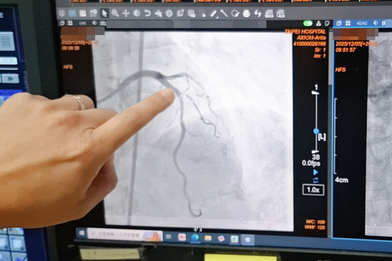 台北醫院心臟內科主任黃啟銘指出,透過血管內震波碎石術擊碎嚴重的鈣化沉積,進而安全完成氣球擴張與支架置放。(衛福部台北醫院提供) 台北醫院心臟內科主任黃啟銘指出,透過血管內震波碎石術擊碎嚴重的鈣化沉積,進而安全完成氣球擴張與支架置放。(衛福部台北醫院提供)