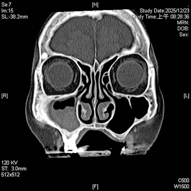 9旬嬤鼻竇炎多年 微創手術解套