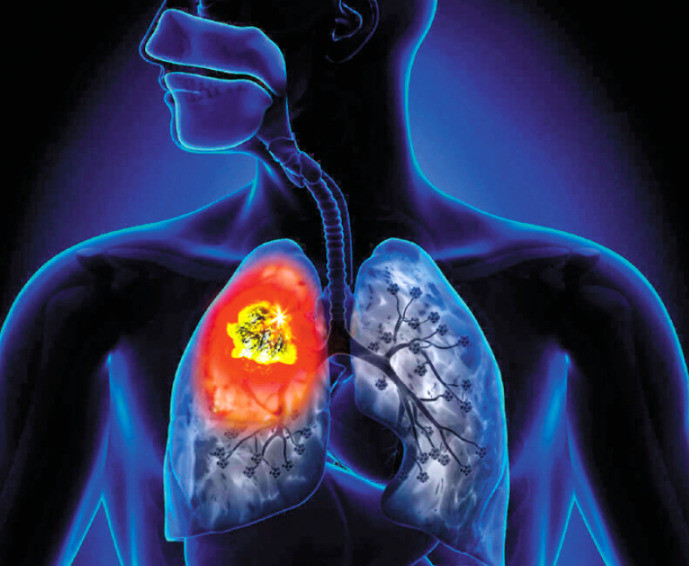 研究：發炎機制促進致命肺癌侵襲性 關鍵在於缺乏特定蛋白質