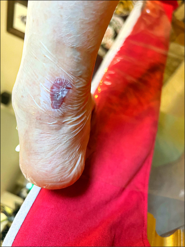 ▲患者的腳跟出現低溫燙傷。(照片提供/醫師林欣儀) ▲患者的腳跟出現低溫燙傷。(照片提供/醫師林欣儀)