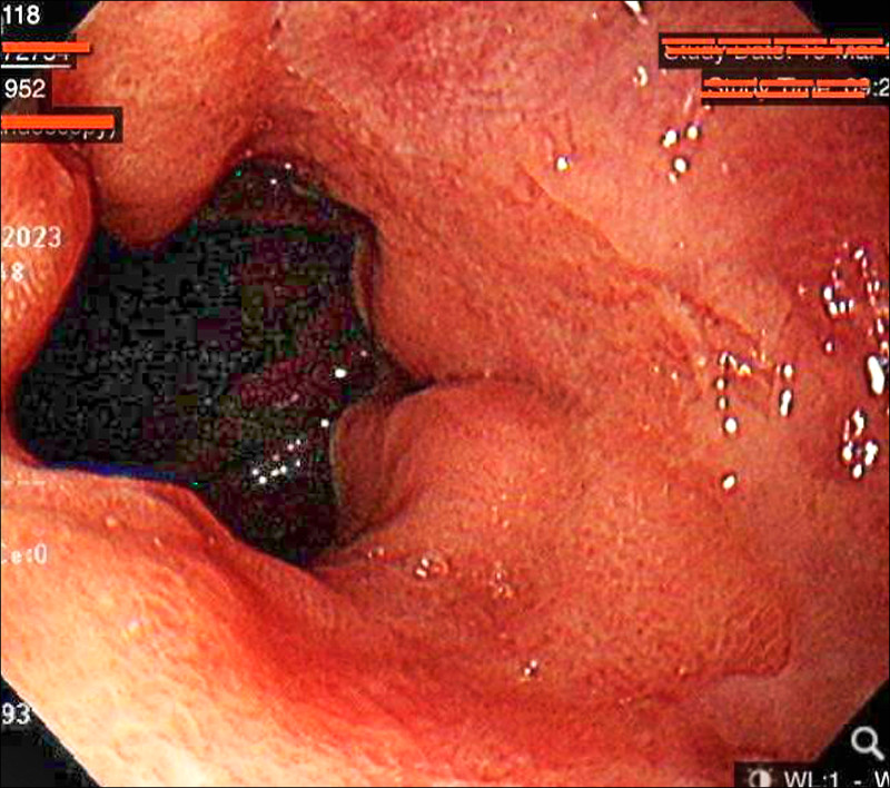 ▲有患者冬天每週狂嗑3、4次麻辣鍋,導致胃食道逆流,胃鏡檢查亦發現有胃潰瘍。(阮綜合醫院提供) ▲有患者冬天每週狂嗑3、4次麻辣鍋,導致胃食道逆流,胃鏡檢查亦發現有胃潰瘍。(阮綜合醫院提供)