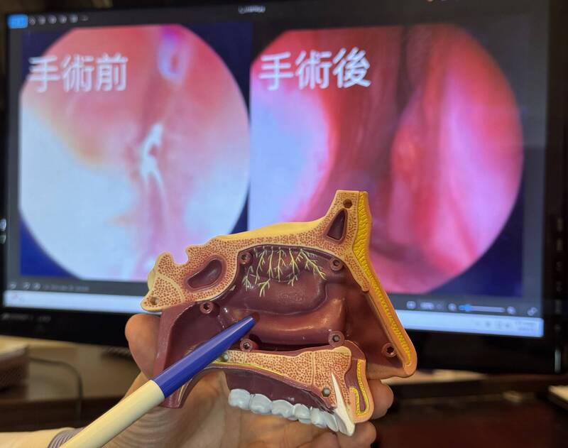 林鴻穎醫師利用模型說明後鼻神經位置,「後鼻神經阻斷手術」利用低溫射頻阻斷與過敏。(中山醫院提供) 林鴻穎醫師利用模型說明後鼻神經位置,「後鼻神經阻斷手術」利用低溫射頻阻斷與過敏。(中山醫院提供)