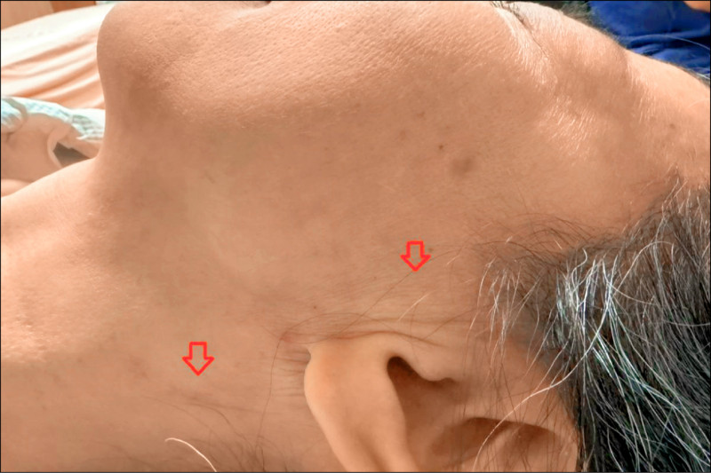 腮腺癌憂手術毀容 切除修補手術找回自信