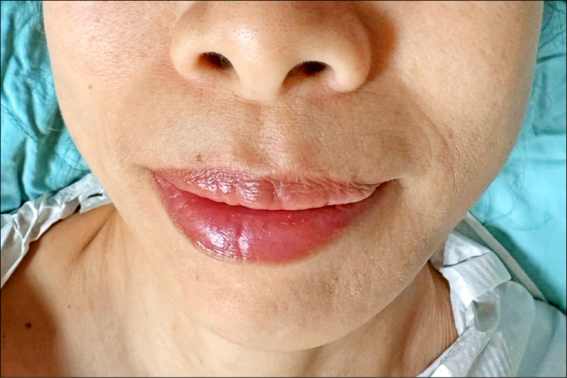 腮腺癌憂手術毀容 切除修補手術找回自信