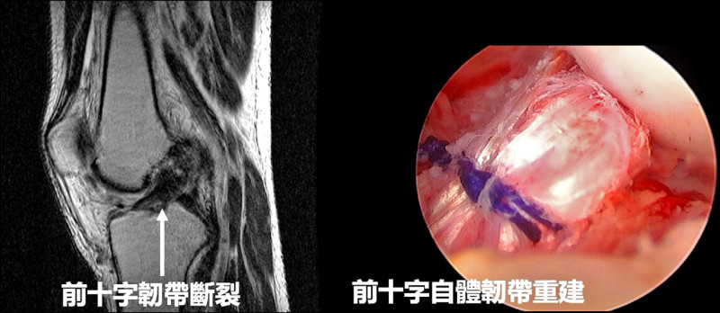 滑雪摔跤 害前十字韌帶撕裂