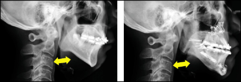 正顎手術 成功改善阻塞型睡眠呼吸中止症