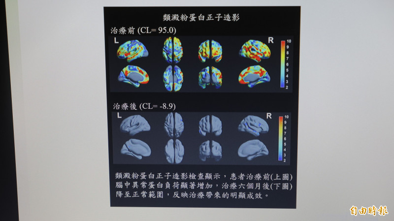 類澱粉蛋白正子造影檢查顯示,患者治療前(上圖)腦中異常蛋白負荷顯著增加,治療6個月後(下圖)降至正常範圍。(記者黃政嘉攝) 類澱粉蛋白正子造影檢查顯示,患者治療前(上圖)腦中異常蛋白負荷顯著增加,治療6個月後(下圖)降至正常範圍。(記者黃政嘉攝)