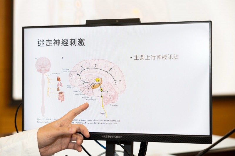 藥物頑固性癲癇難治 成大醫：迷走神經刺激術有緩解效果