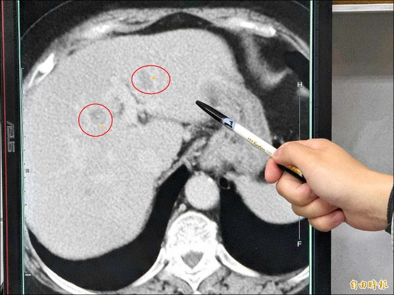 ▲婦人的肝臟檢查出有腫瘤。(記者張軒哲攝) ▲婦人的肝臟檢查出有腫瘤。(記者張軒哲攝)