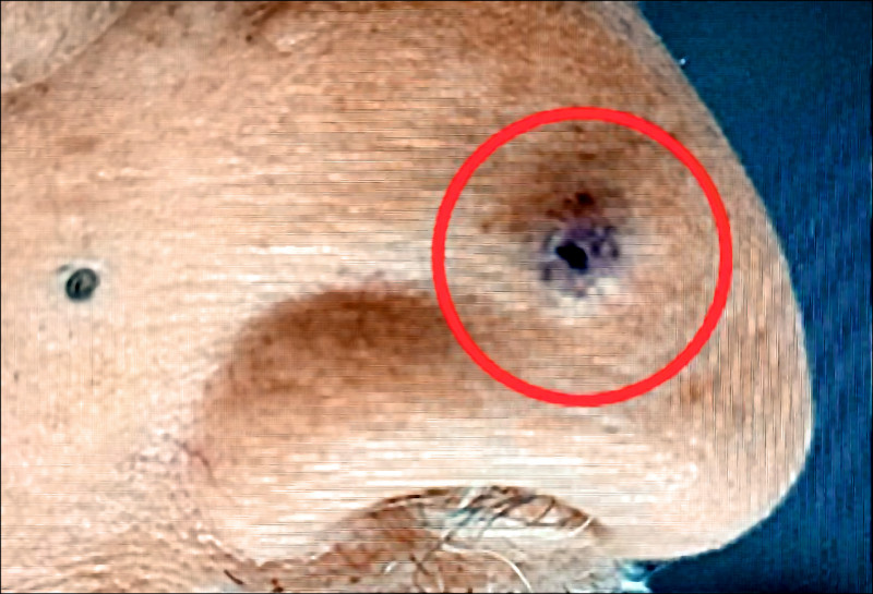 不痛不癢 老翁鼻黑痣拖2年變皮膚癌