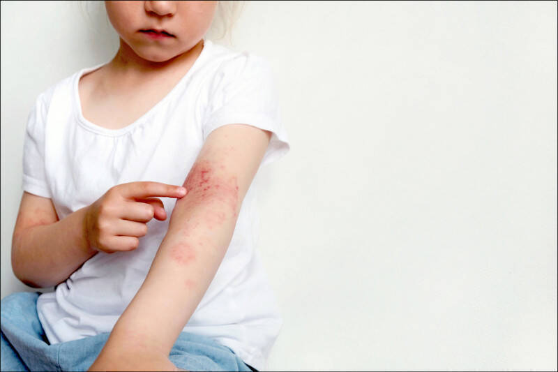 兒童感染科醫師顏俊宇表示,刷毛衣物雖保暖,但對皮膚敏感或有過敏體質的小孩來說,恐是刺激皮膚的隱形地雷,容易導致熱疹發作;情境照。(圖取自shutterstock) 兒童感染科醫師顏俊宇表示,刷毛衣物雖保暖,但對皮膚敏感或有過敏體質的小孩來說,恐是刺激皮膚的隱形地雷,容易導致熱疹發作;情境照。(圖取自shutterstock)