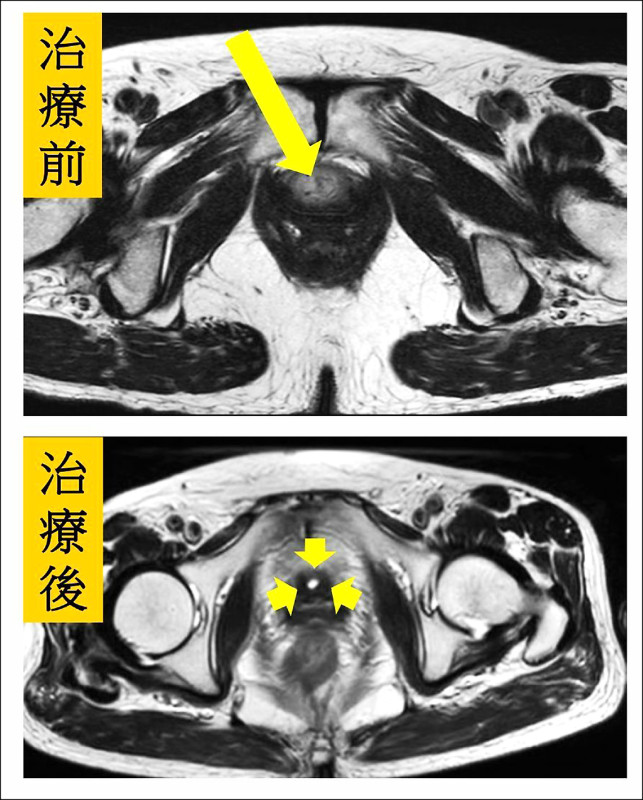 ▲李姓婦人治療前核磁共振檢查發現尿道完全被腫瘤阻塞(上圖),治療後發現尿道已無腫瘤(下圖)。(記者陳建志翻攝) ▲李姓婦人治療前核磁共振檢查發現尿道完全被腫瘤阻塞(上圖),治療後發現尿道已無腫瘤(下圖)。(記者陳建志翻攝)