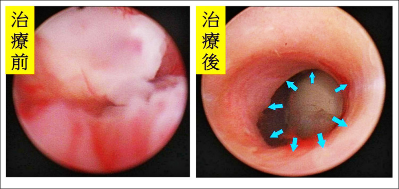 ▲李姓婦人術前內視鏡發現尿道完全被腫瘤阻塞(左圖),治療後內視鏡已無看到腫瘤(右圖)。(記者陳建志翻攝) ▲李姓婦人術前內視鏡發現尿道完全被腫瘤阻塞(左圖),治療後內視鏡已無看到腫瘤(右圖)。(記者陳建志翻攝)
