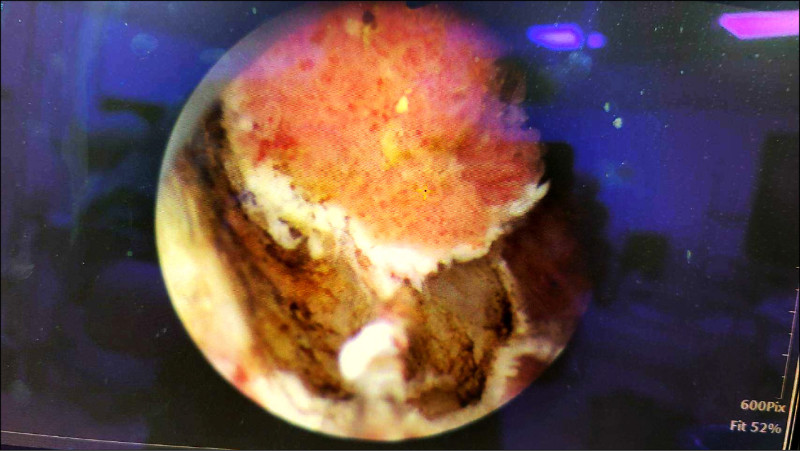 ▲攝護腺肥大使表面佈滿脆弱的靜脈曲張血管叢,一旦血管破裂可能導致大量出血並在膀胱內形成血塊,嚴重會引發尿滯留及出血性休克。(民生醫院提供) ▲攝護腺肥大使表面佈滿脆弱的靜脈曲張血管叢,一旦血管破裂可能導致大量出血並在膀胱內形成血塊,嚴重會引發尿滯留及出血性休克。(民生醫院提供)