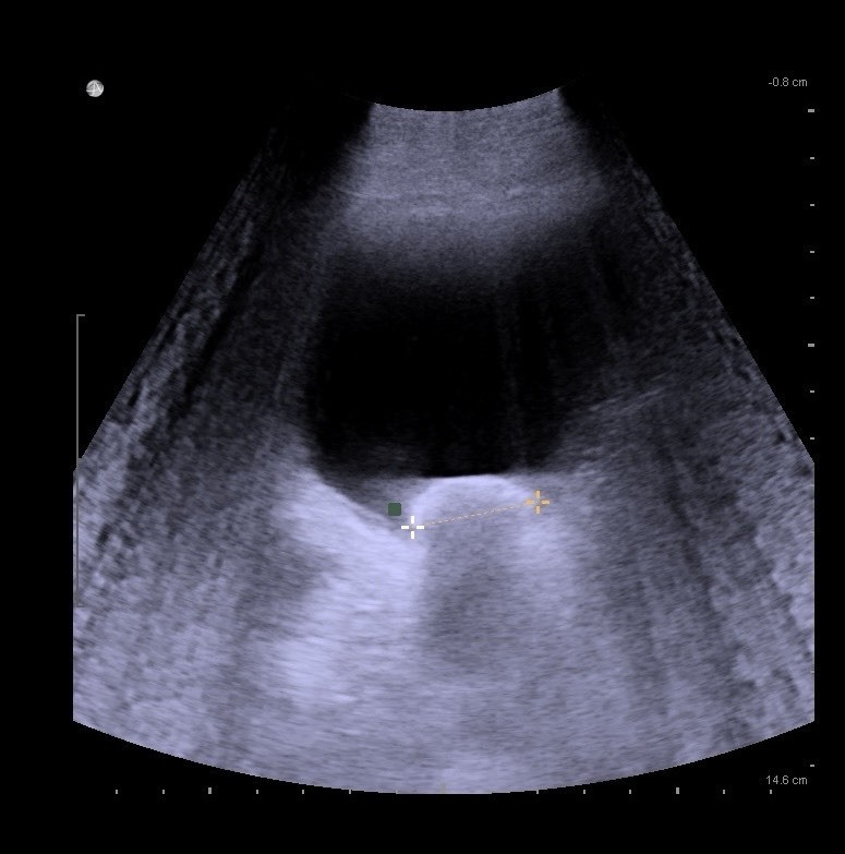 1名39歲壯年男子最近發現排尿時尿流會中斷,超音波掃描膀胱,赫然發現1顆2.5公分大的結石。(新營醫院提供) 1名39歲壯年男子最近發現排尿時尿流會中斷,超音波掃描膀胱,赫然發現1顆2.5公分大的結石。(新營醫院提供)