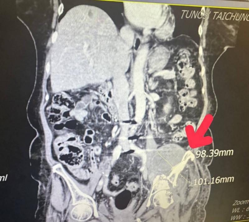 紅色箭頭即為進行銳視刀適應性放射治療利用空間分割點狀治療方式,配合傳統銳視刀治。(記者歐素美翻攝) 紅色箭頭即為進行銳視刀適應性放射治療利用空間分割點狀治療方式,配合傳統銳視刀治。(記者歐素美翻攝)