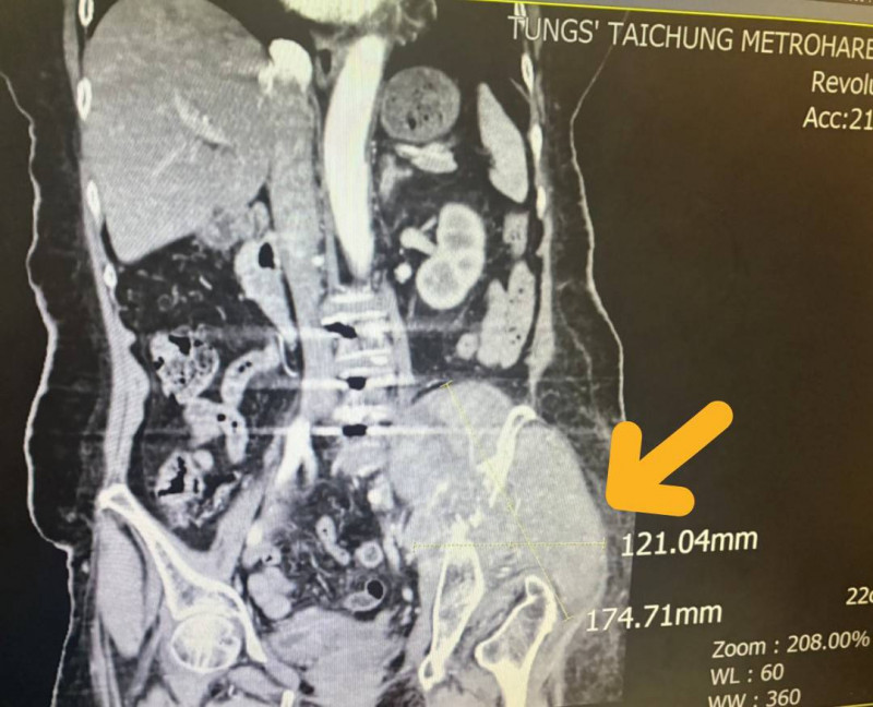 黃色箭頭即為患者左側骨盆骶骨處出現異常12.1公分x17.4公分左右大型腫瘤細胞。(記者歐素美翻攝) 黃色箭頭即為患者左側骨盆骶骨處出現異常12.1公分x17.4公分左右大型腫瘤細胞。(記者歐素美翻攝)