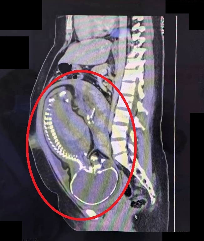 該名孕婦已懷孕39週(紅圈處為腹中寶寶),在跨團隊合作下,順利生產並處理急性盲腸炎問題。(大千醫院提供) 該名孕婦已懷孕39週(紅圈處為腹中寶寶),在跨團隊合作下,順利生產並處理急性盲腸炎問題。(大千醫院提供)