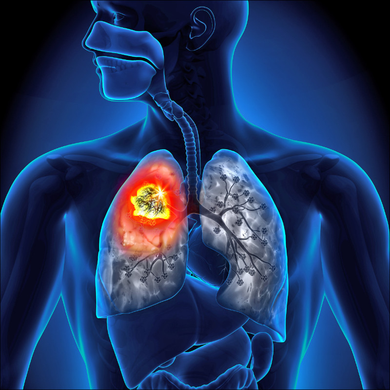 反駁LDCT篩檢害白挨刀 衛福部：92％確診肺癌
