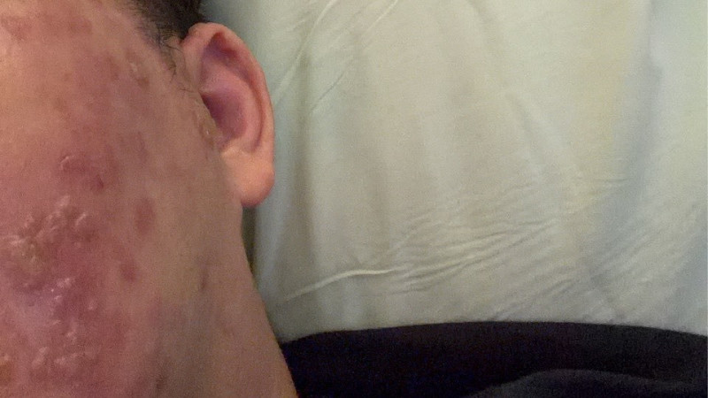 牙痛失眠3天引「蛇」出洞！帶狀疱疹發作 醫：恐失明失聰