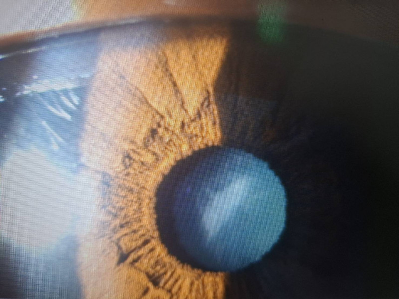 高雄6旬婦白內障長出「Team Taiwan」 連醫師都稱奇