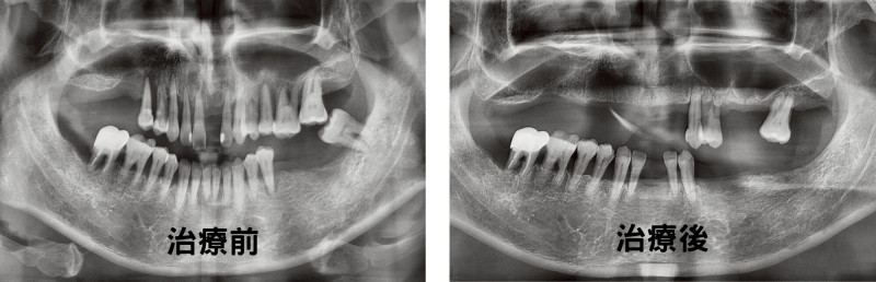 男性桃園市民治療後保住11顆牙齒。(圖由聯新國際醫院提供) 男性桃園市民治療後保住11顆牙齒。(圖由聯新國際醫院提供)