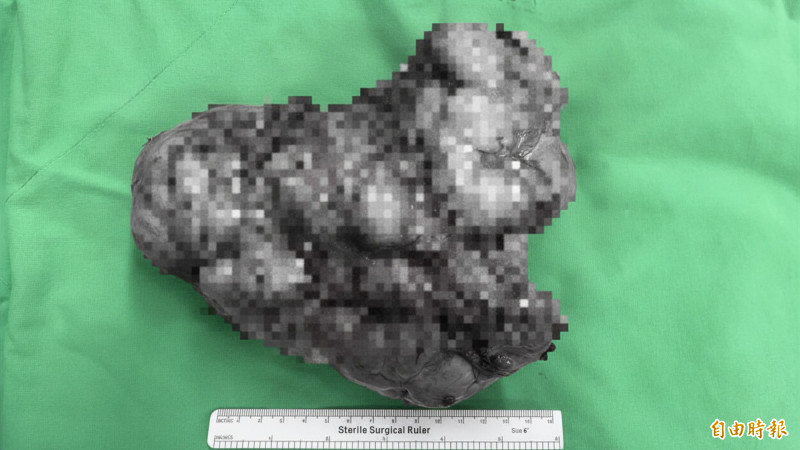 七旬翁多次低血糖昏迷 肺裡藏25公分巨瘤