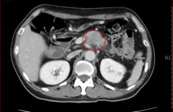 5旬男長期酗酒又有糖尿病 查出罹胰臟癌2期