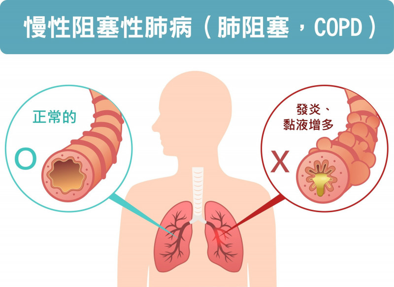 肺阻塞成全球第3大死因卻有高未診斷率 北市聯醫籲高風險族群提高警覺