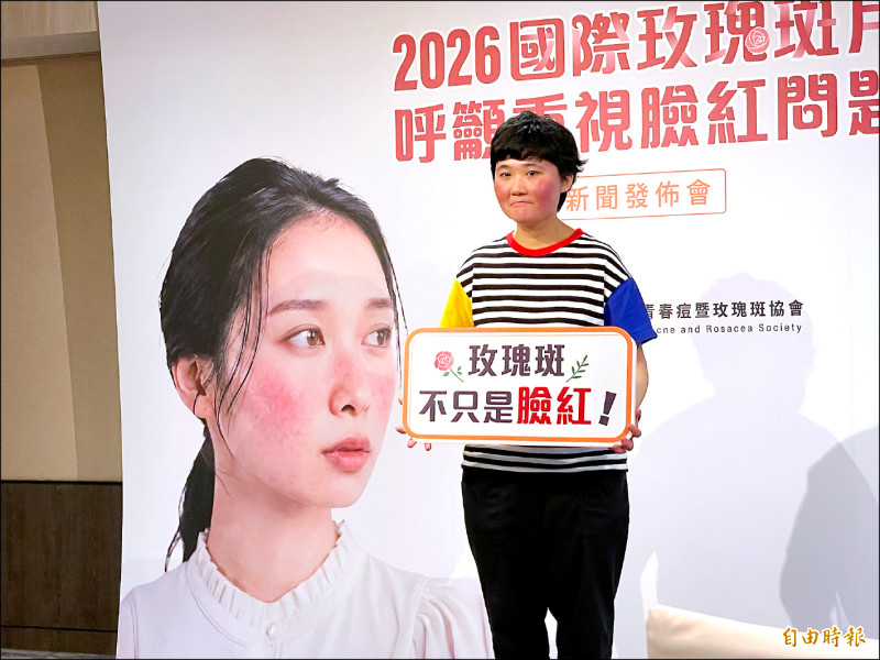 臉紅被當異位性皮膚炎 拖6年確診玫瑰斑