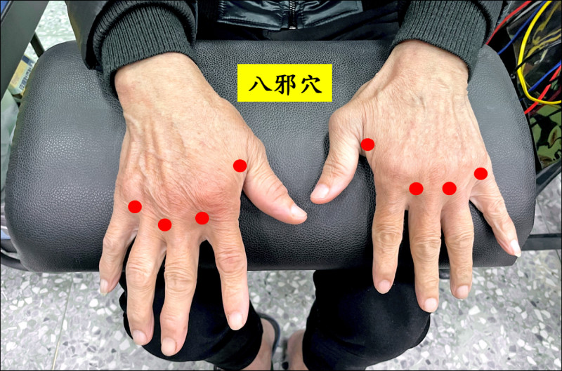 ▲針灸「八邪穴」能有效疏通經絡、促進血液循環,緩解關節腫脹與僵硬。(台南市立醫院提供) ▲針灸「八邪穴」能有效疏通經絡、促進血液循環,緩解關節腫脹與僵硬。(台南市立醫院提供)