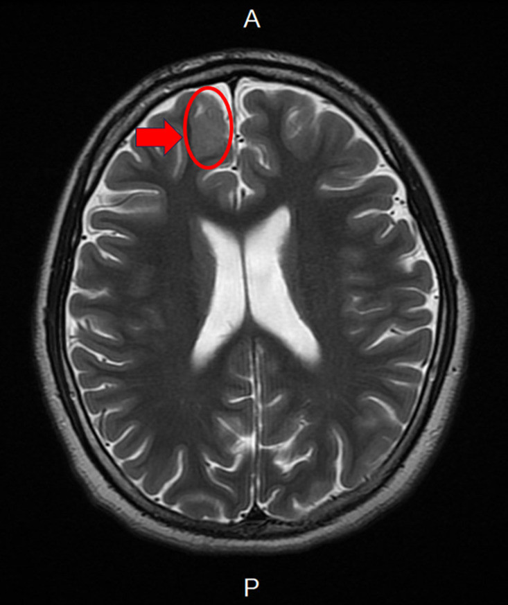 14歲少年癲癇規律服藥仍頻繁發作  疑腦皮質發育不良