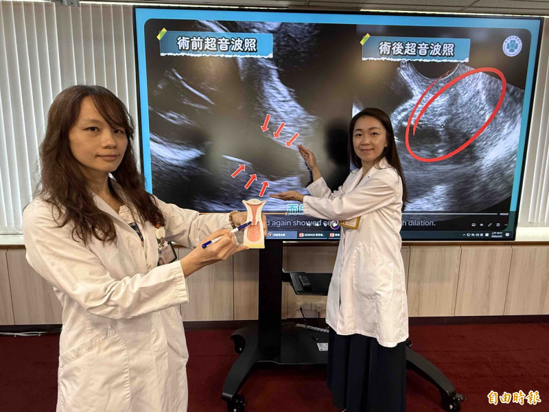 陳雅芳(左)與林俐伶醫師指丁小姐懷孕24週時發生子宮頸閉鎖不全,手術進行環紮手術。(記者蔡淑媛攝) 陳雅芳(左)與林俐伶醫師指丁小姐懷孕24週時發生子宮頸閉鎖不全,手術進行環紮手術。(記者蔡淑媛攝)