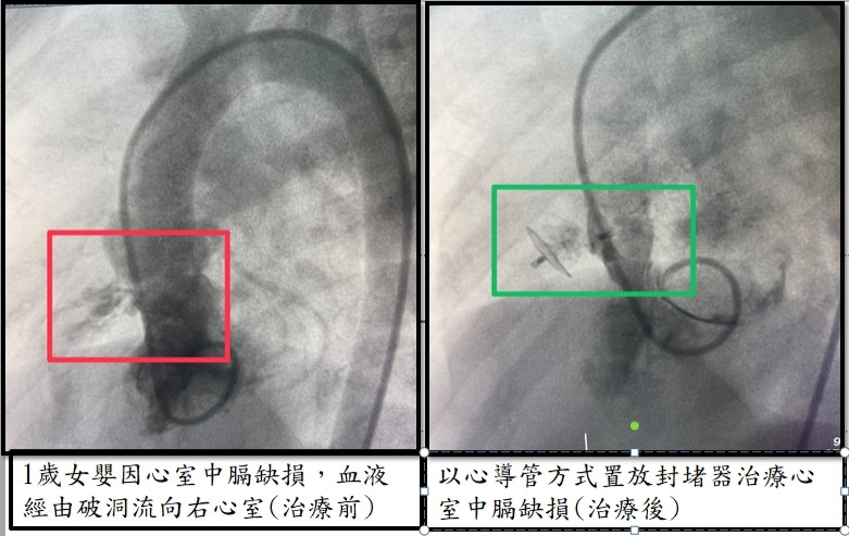 1歲4月大女童有心室中膈缺損,透過微創手術免開心治療,紅色是治療前、綠色是治療後。(台中榮總嘉義分院提供) 1歲4月大女童有心室中膈缺損,透過微創手術免開心治療,紅色是治療前、綠色是治療後。(台中榮總嘉義分院提供)