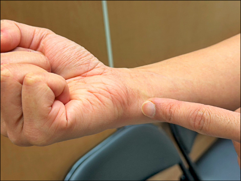 「戰鬥陀螺」玩到手殘 醫：開戰前務必「手腕熱身」