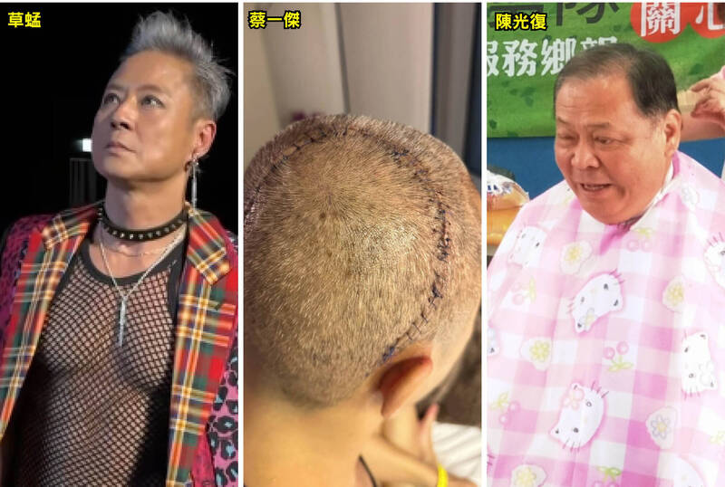 健康網》蔡一傑腦瘤開顱後「更有力」 醫揭「骨板復位效應」：手腳竟會更有力