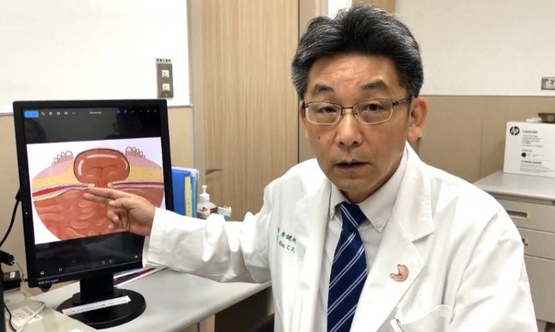 6旬婦腫出「肚皮氣球」 原是女性疝氣、達文西手術恢復平整