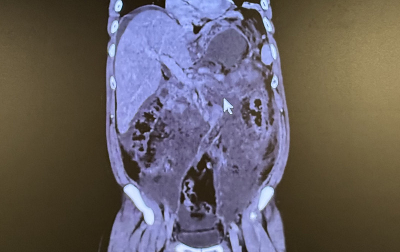 39歲男誤當胃脹氣！竟是「壞死性胰臟炎」 死亡率達6成