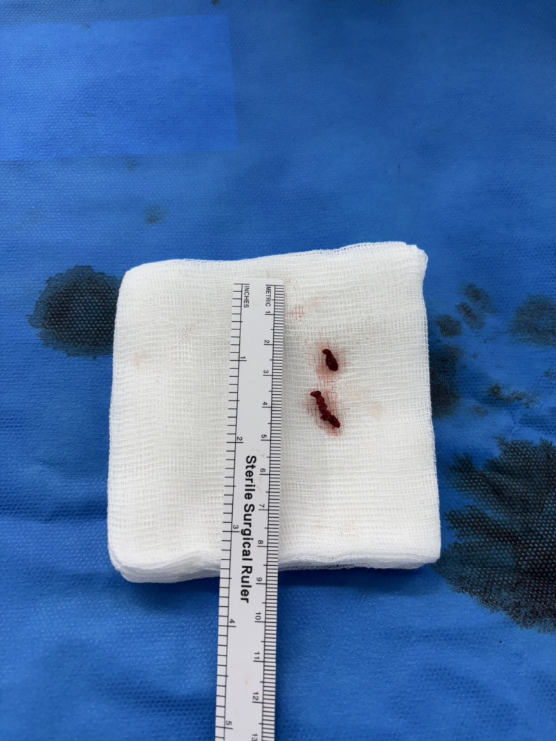 急性腦中風與時間賽跑   高雄秀傳建構取栓治療體系