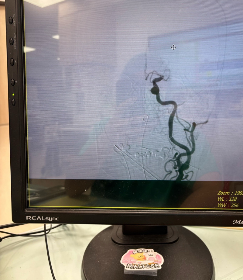 急性腦中風經動脈取栓術前顯示中大腦動脈主幹阻塞。(高雄秀傳醫院提供) 急性腦中風經動脈取栓術前顯示中大腦動脈主幹阻塞。(高雄秀傳醫院提供)